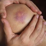 Unlocking the Benefits of Vitamin K for Bruising Relief