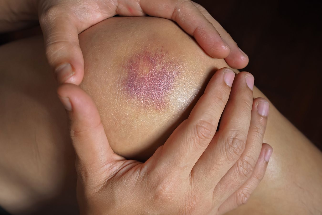 vitamin k for bruising